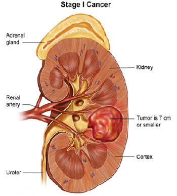 Kidney Oncology